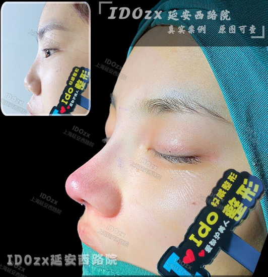 上海周光杰做鼻子怎么样