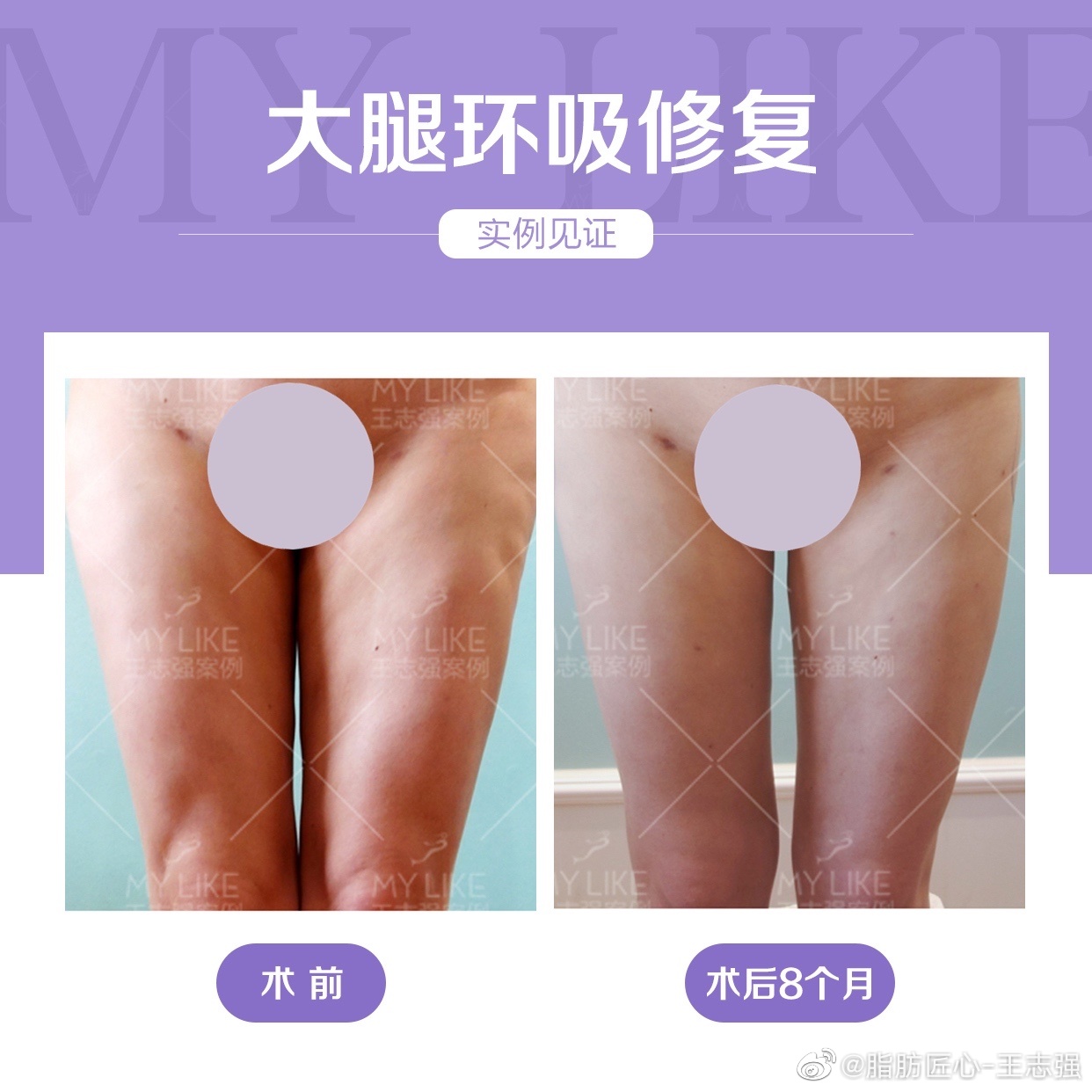 王志强大腿环吸案例